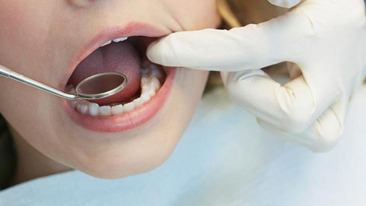20 Yaş Dişleri ve Çene Sağlığı: Çekim Gerekliliği ve Süreci