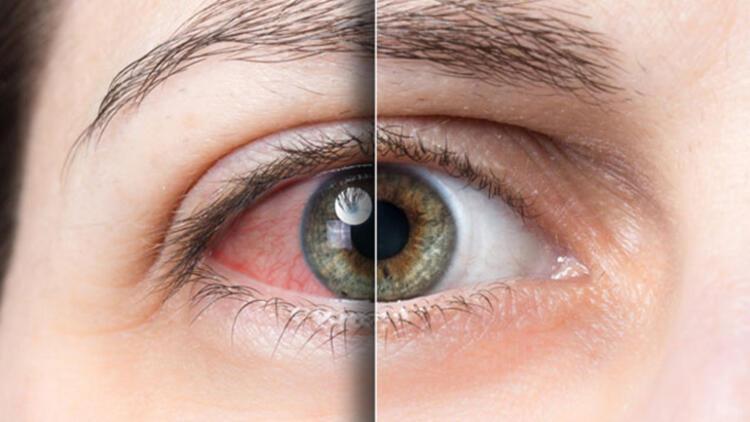 Alerji Nedir? Alerjik Rinit Belirtileri ve Tedavi Yöntemleri