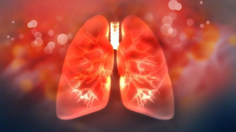 Alveoler Mikrolitiazis: Nadir Bir Akciğer Hastalığı