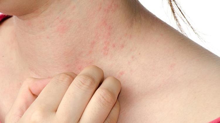 Besin Alerjisi: Nedenleri, Belirtileri ve Tedavi Yöntemleri