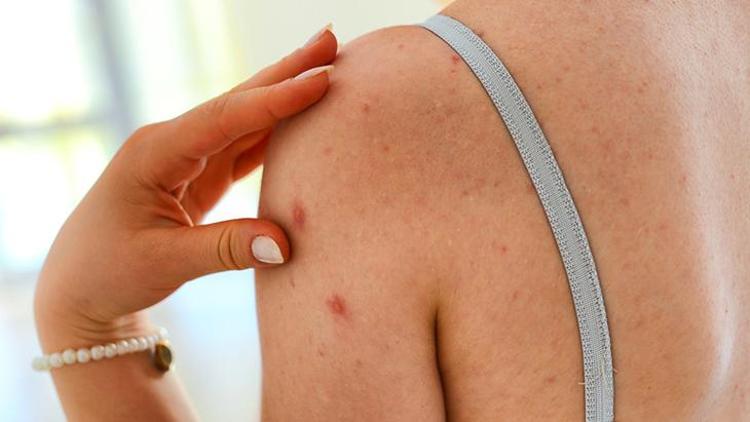 Besin Alerjisi: Nedenleri, Belirtileri ve Tedavi Yöntemleri
