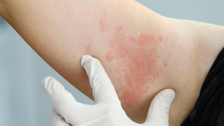 Besin Alerjisi: Nedenleri, Belirtileri ve Tedavi Yöntemleri