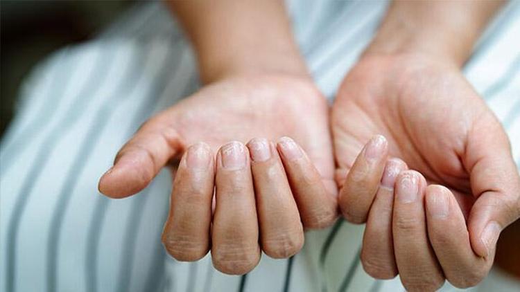 De Quervain Sendromu: Nedenleri, Belirtileri ve Tedavi Yöntemleri