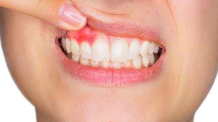 Diş Fırçanızın Kılları Çabuk Yıpranır