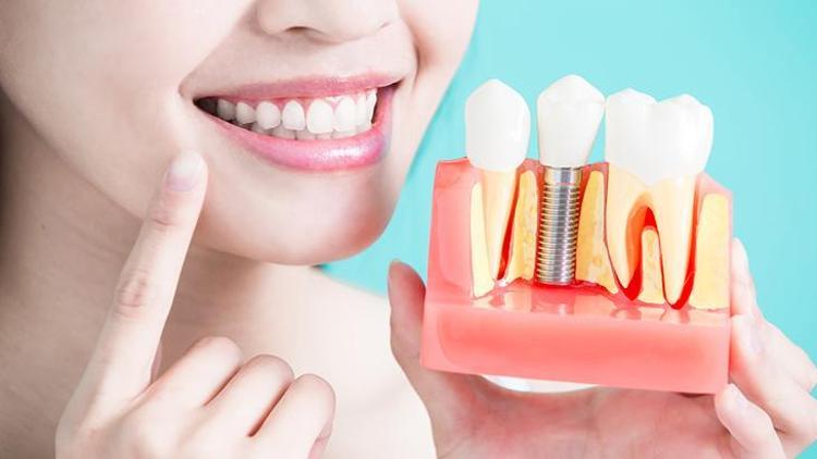 Diş İmplantı: Uygulama, Sorunlar ve Çözüm Yöntemleri
