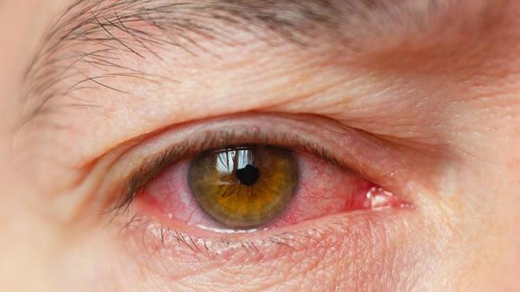 Diyabetik Retinopati: Belirtileri, Risk Faktörleri ve Önleme Yöntemleri