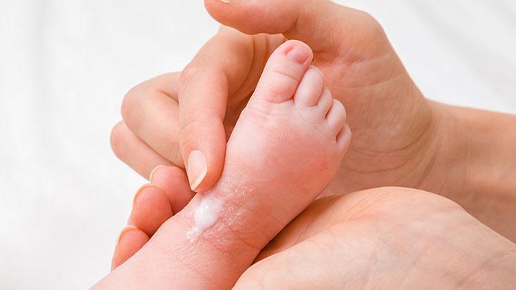 Egzama: Belirtileri, Nedenleri ve Tedavi Yöntemleri