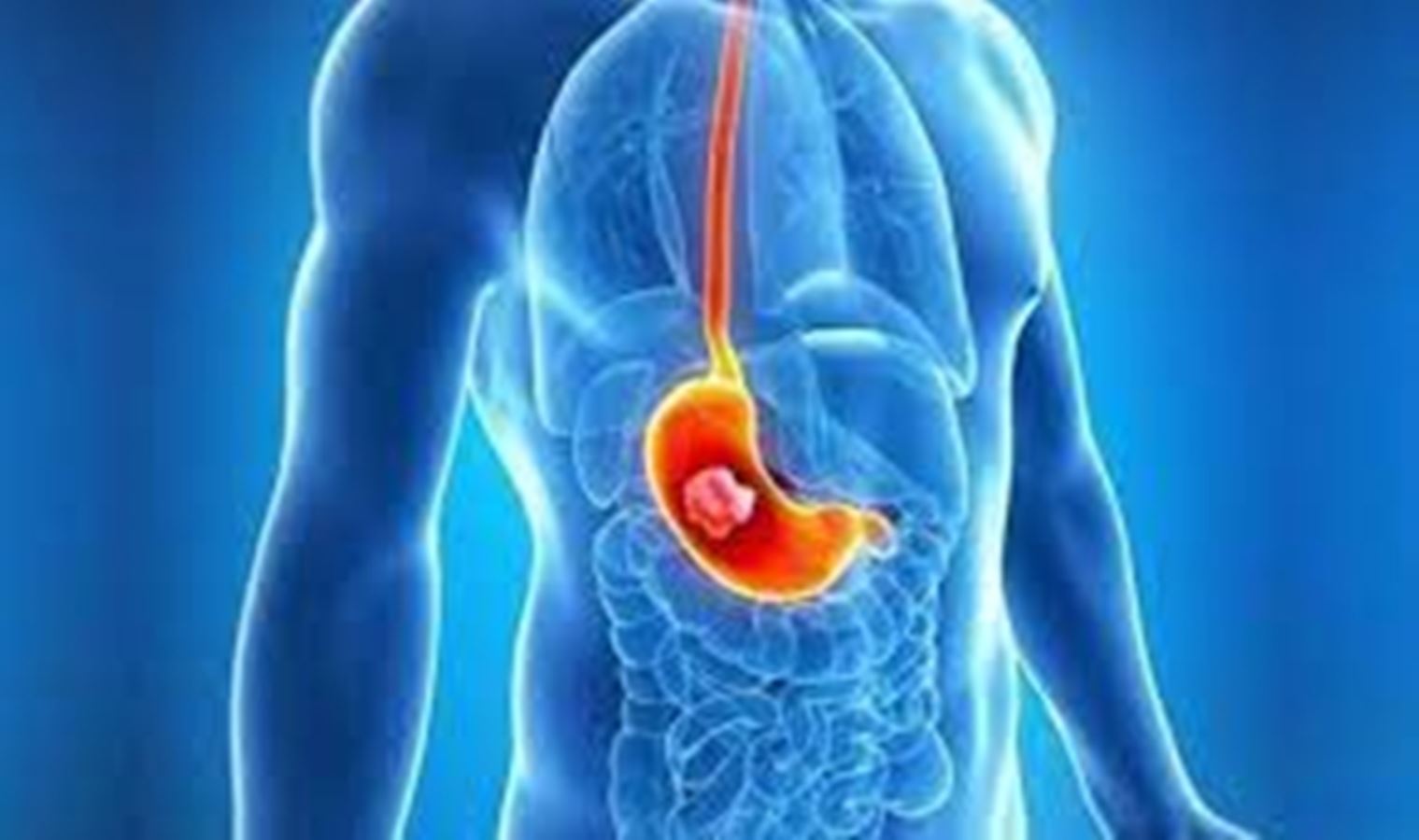Gastrit Nedenleri
