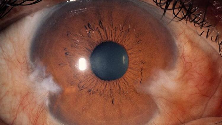 Pterjium'un Gelişimi