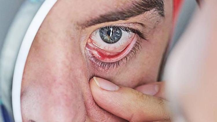 Göz Kızarıklığı ve Pterjium: Belirtiler, Tedavi ve Uzun Süreli Etkiler