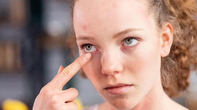 Göz Kızarıklığı ve Pterjium: Belirtiler, Tedavi ve Uzun Süreli Etkiler