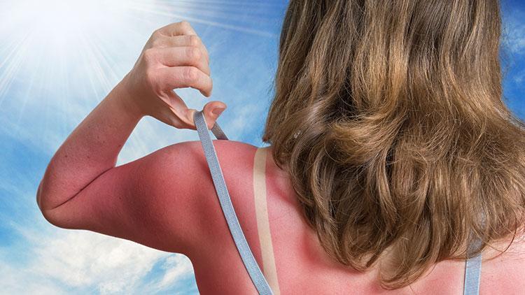 Güneş Alerjisi Nedir?