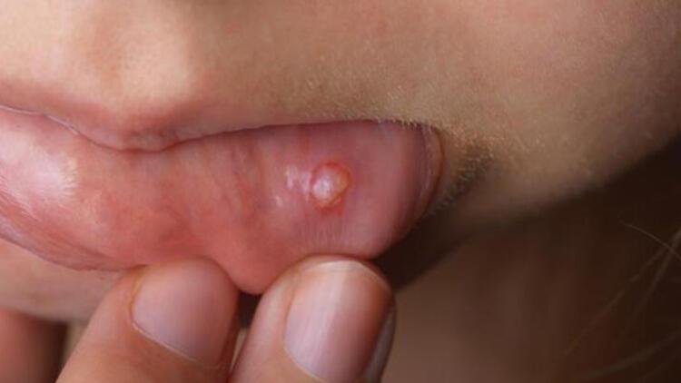 Herpes Simpleks Enfeksiyonu ve Uçuk Tedavisi