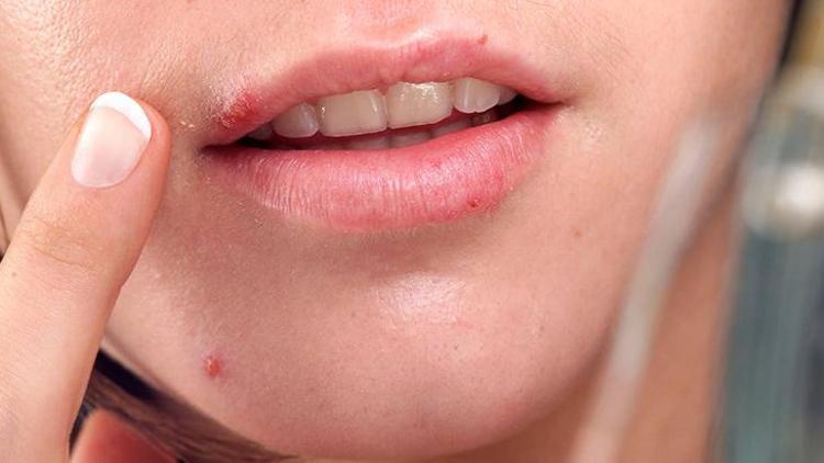 Herpes Simpleks Enfeksiyonu ve Uçuk Tedavisi