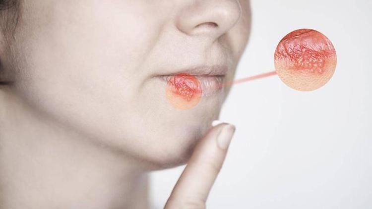 Herpes Simpleks Enfeksiyonu ve Uçuk Tedavisi
