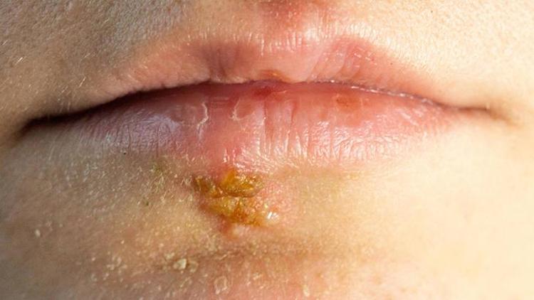 Herpes Simpleks Enfeksiyonu ve Uçuk Tedavisi