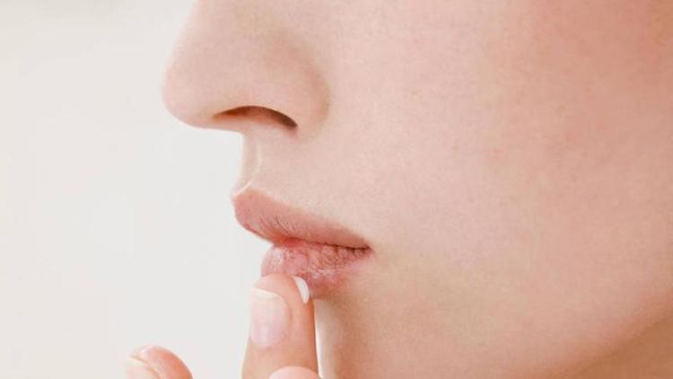 Herpes Simpleks Enfeksiyonu ve Uçuk Tedavisi