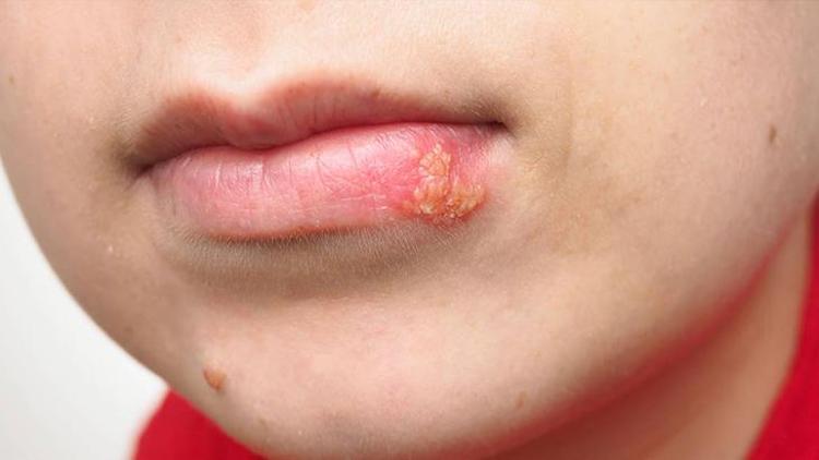 Herpes Simpleks Enfeksiyonu ve Uçuk Tedavisi