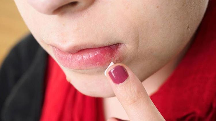 Herpes Simpleks Enfeksiyonu ve Uçuk Tedavisi