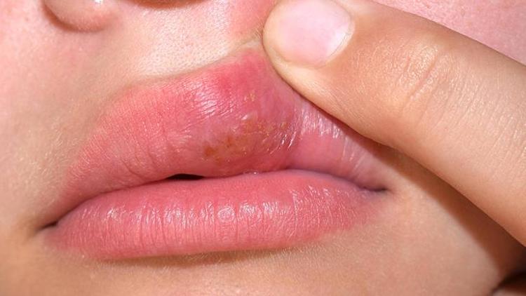 Herpes Simpleks Enfeksiyonu ve Uçuk Tedavisi