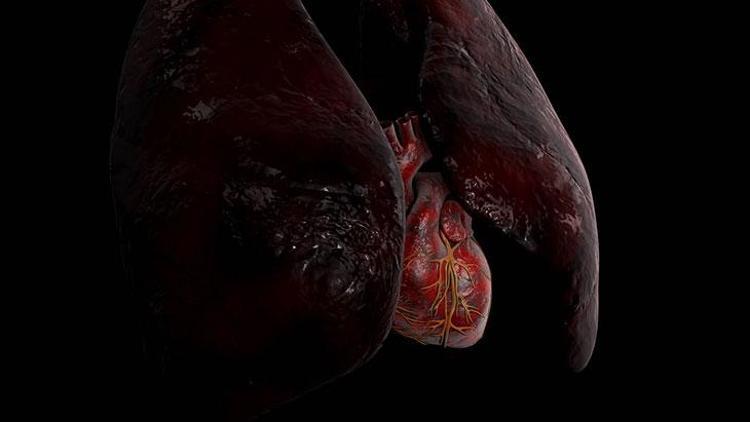 İdiyopatik Pulmoner Fibrozis (İPF): Belirtiler, Tanı ve Tedavi Yöntemleri