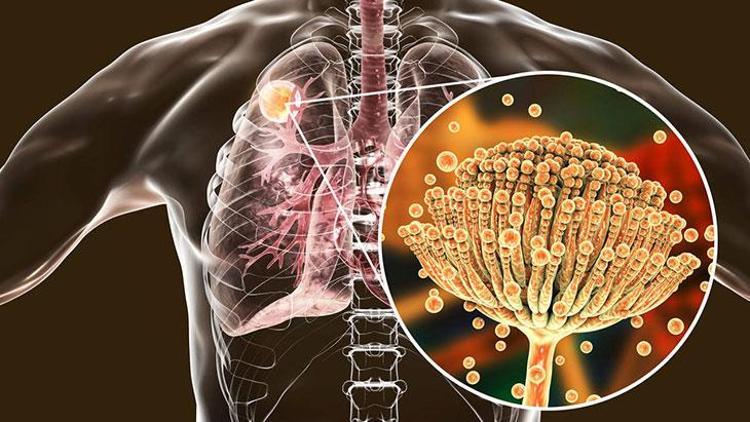 İdiyopatik Pulmoner Fibrozis (İPF): Belirtiler, Tanı ve Tedavi Yöntemleri