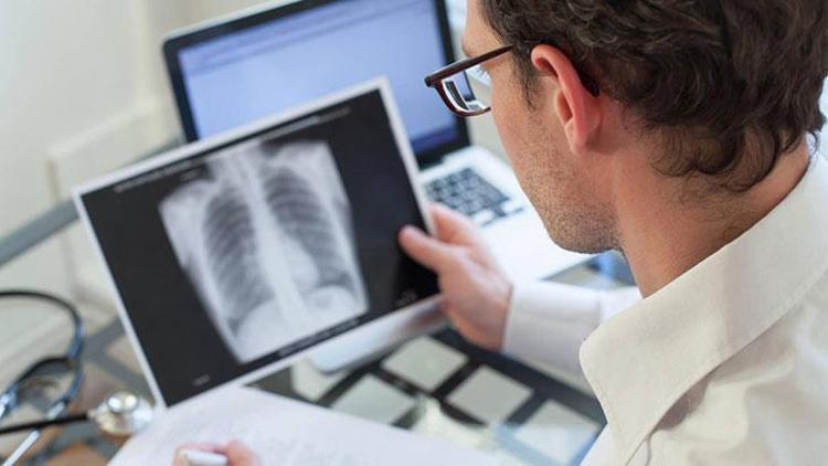 İdiyopatik Pulmoner Fibrozis (İPF): Belirtiler, Tanı ve Tedavi Yöntemleri