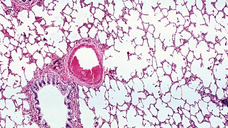 İdiyopatik Pulmoner Fibrozis (İPF): Belirtiler, Tanı ve Tedavi Yöntemleri