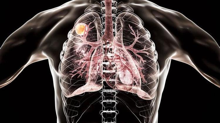 İdiyopatik Pulmoner Fibrozis (İPF): Belirtileri, Tanısı ve Tedavisi