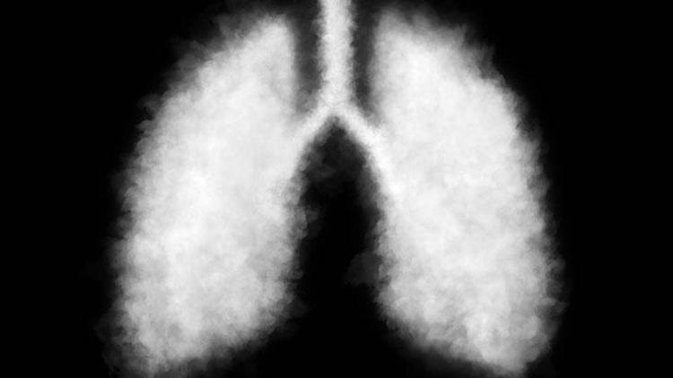 İdiyopatik Pulmoner Fibrozis (İPF): Belirtileri, Tanısı ve Tedavisi