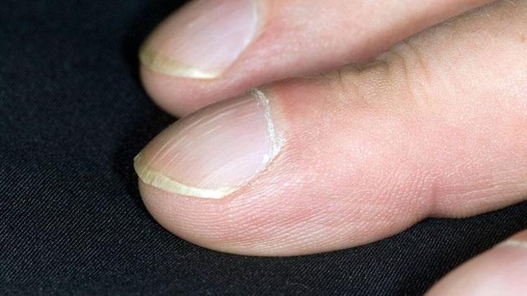 İdiyopatik Pulmoner Fibrozis (İPF): Belirtileri, Tanısı ve Tedavisi