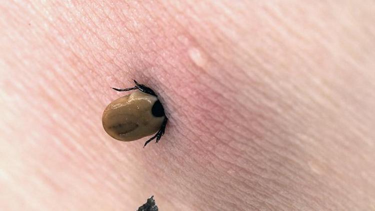 Lyme Hastalığı Nedir?