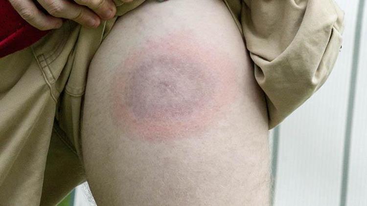 Lyme Hastalığının Belirtileri