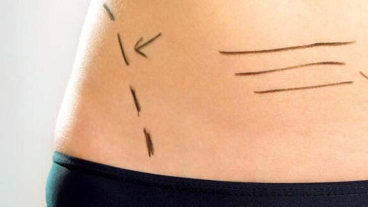 Karın Germe İşlemi: Nedir, Süreci ve Dikkat Edilmesi Gerekenler