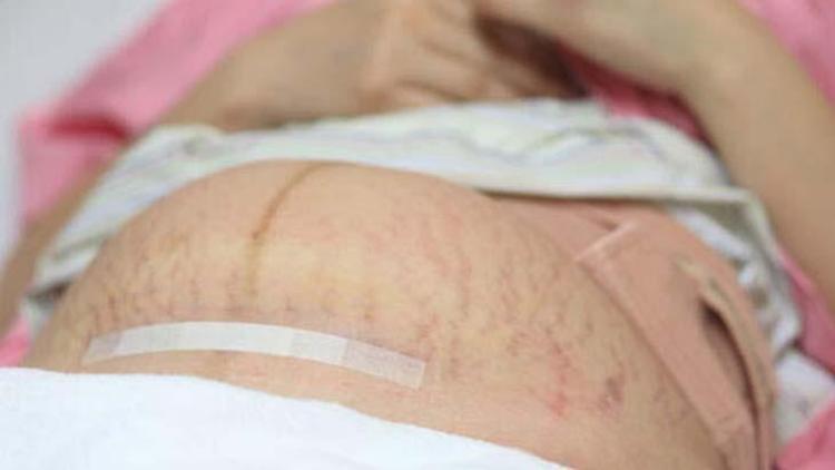 Karın Germe İşlemi: Nedir, Süreci ve Dikkat Edilmesi Gerekenler