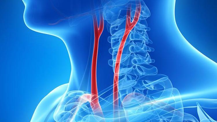 Karotid Arter Darlığı: Nedenleri, Belirtileri ve Tedavi Yöntemleri