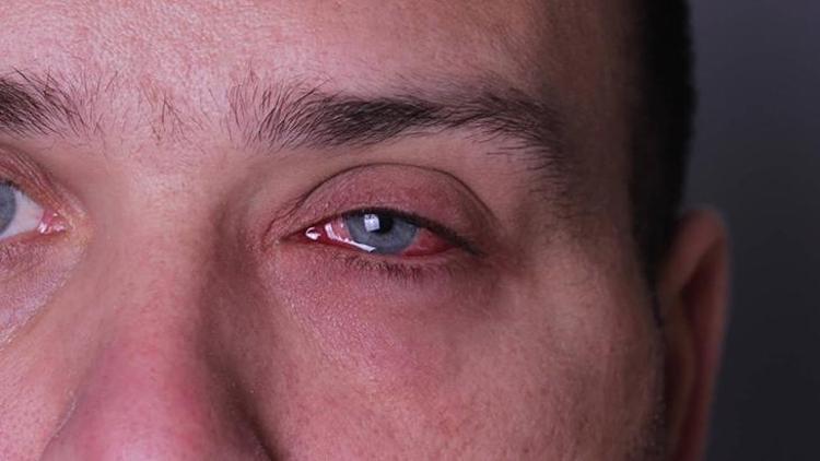 Kırmızı Göz ve Alerjik Konjonktivit: Nedenleri, Belirtileri ve Korunma Yöntemleri