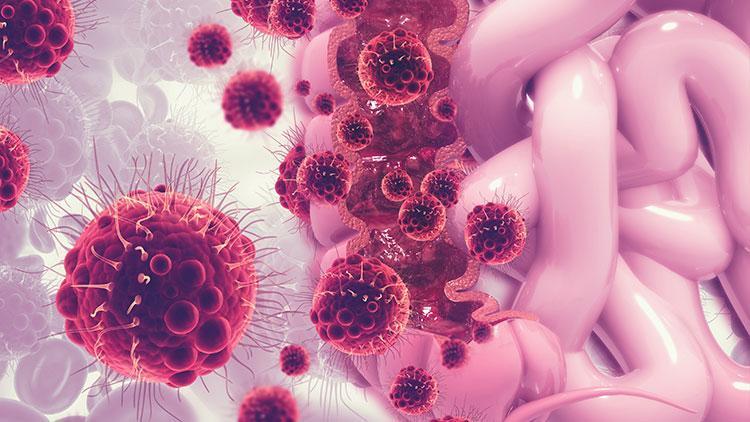 Torba (Stoma) Uygulaması Neden Yapılır?