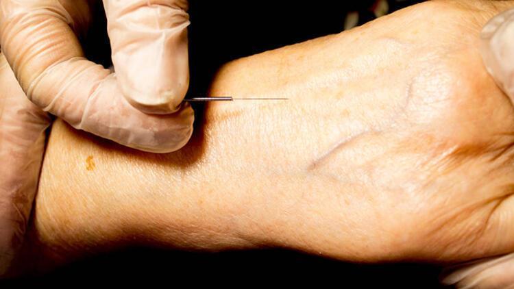Kozmetik Akupunktur: Estetikte Doğal ve Yan Etkisiz Çözüm