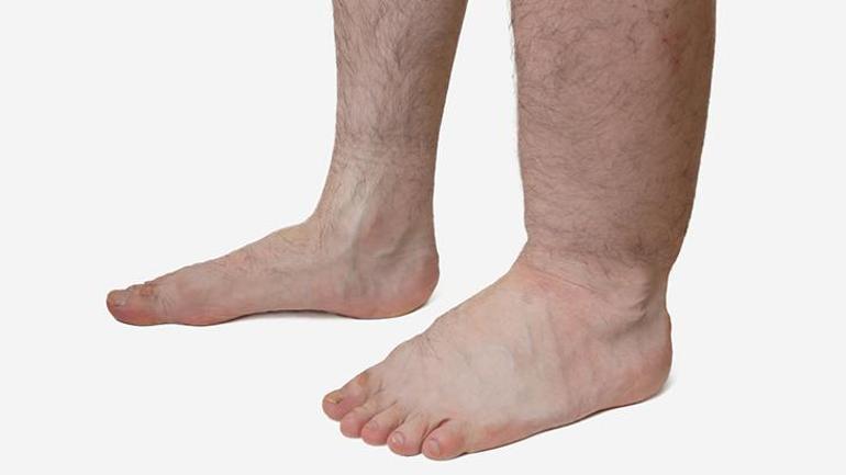 Lenf Damarları ve Lenfödem