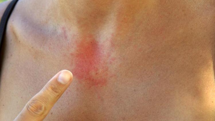 Sistemik Lupus Eritematozus (SLE)