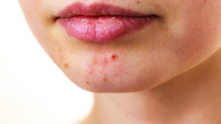 Lupus Hastalığı Nasıl Teşhis Edilir?
