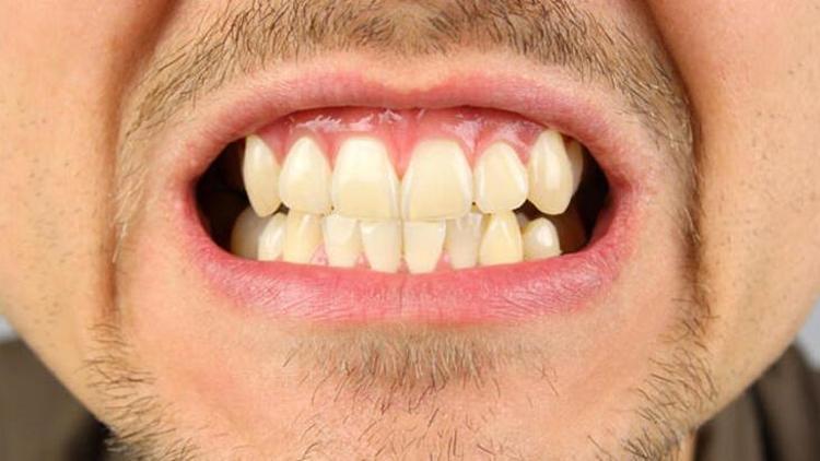 Masseter Botoksu Sonrası Yeme Güçlüğü Olur mu?