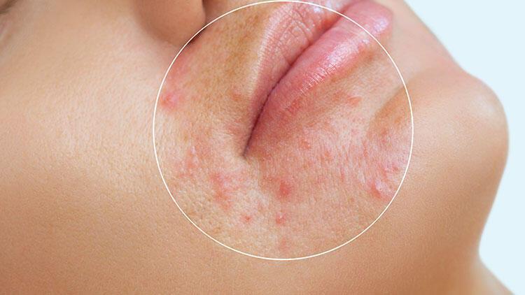 Melanositlerin Rolü ve Güneş Lekeleri Hakkında Bilgi