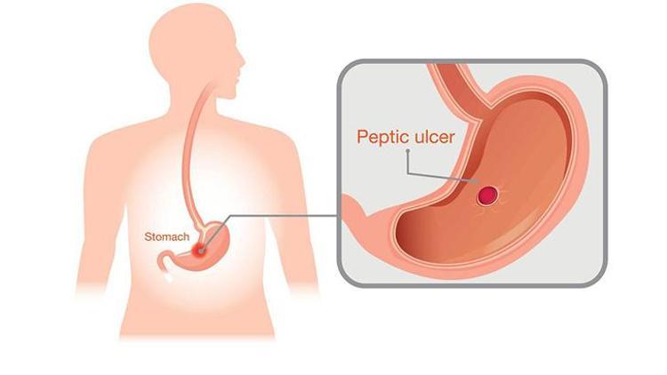 Mide Sağlığı: Ağrı, Gastrit ve Ülser Tedavisi