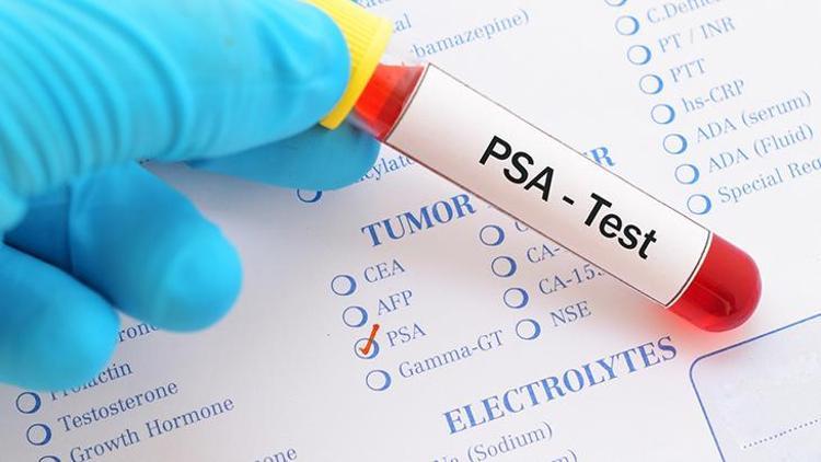 Prostat Biyopsisi ve Tanı Süreci