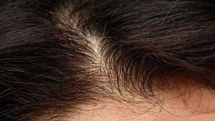 Saç Dökülmesi ve Bakımı: Etkili Çözümler ve Beslenme Önerileri