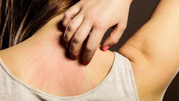 Seboreik Dermatit Hastalarına Tavsiyeler