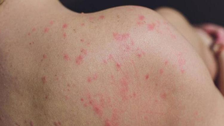Seboreik Dermatit: Belirtileri, Nedenleri ve Tedavi Yöntemleri