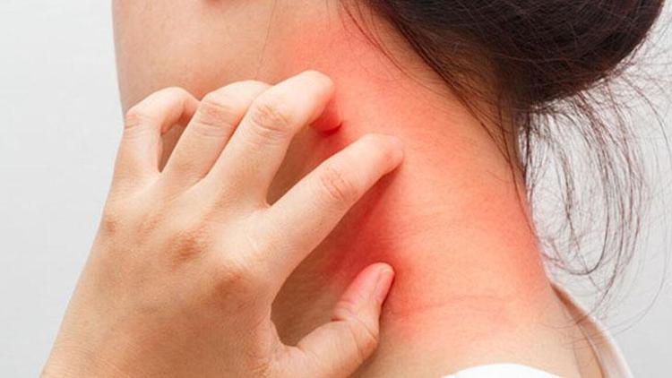 Seboreik Dermatit Kimlerde Görülür?